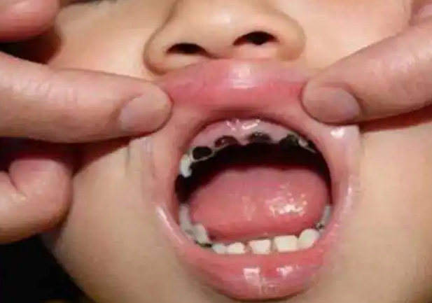 珠海六和口腔兒童齲齒