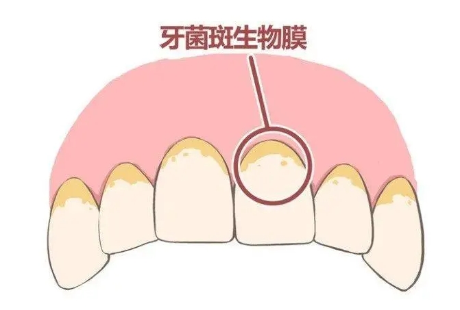 珠海鼎植口腔醫院牙菌斑