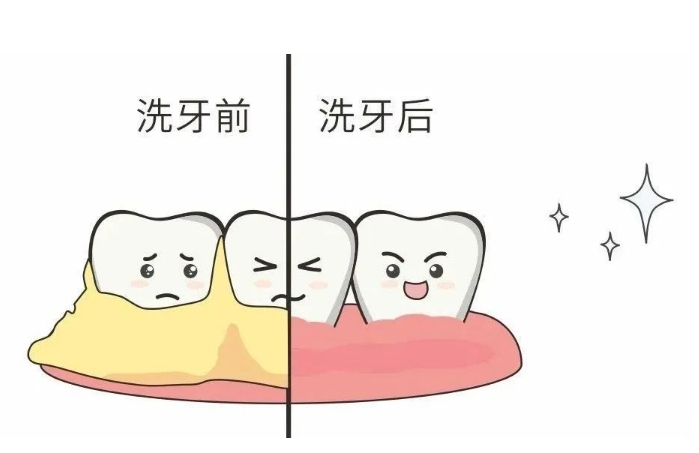 珠海鼎植口腔醫院洗牙