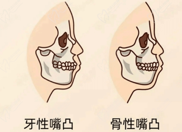 珠海鼎植口腔醫院牙齒突出