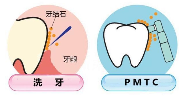 珠海鼎植口腔醫院PMTC