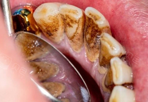 珠海六和口腔醫院牙菌斑