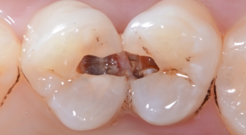 珠海六和口腔醫(yī)院蛀牙